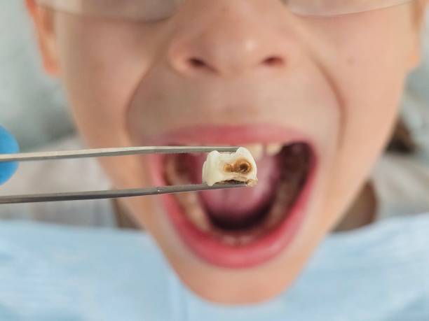 Best Broken Tooth Emergency  in Kirkl, IN